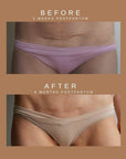 Restorative C-Section Scar Cream